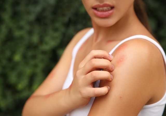 Comment soulager et prévenir les piqûres de moustiques ?